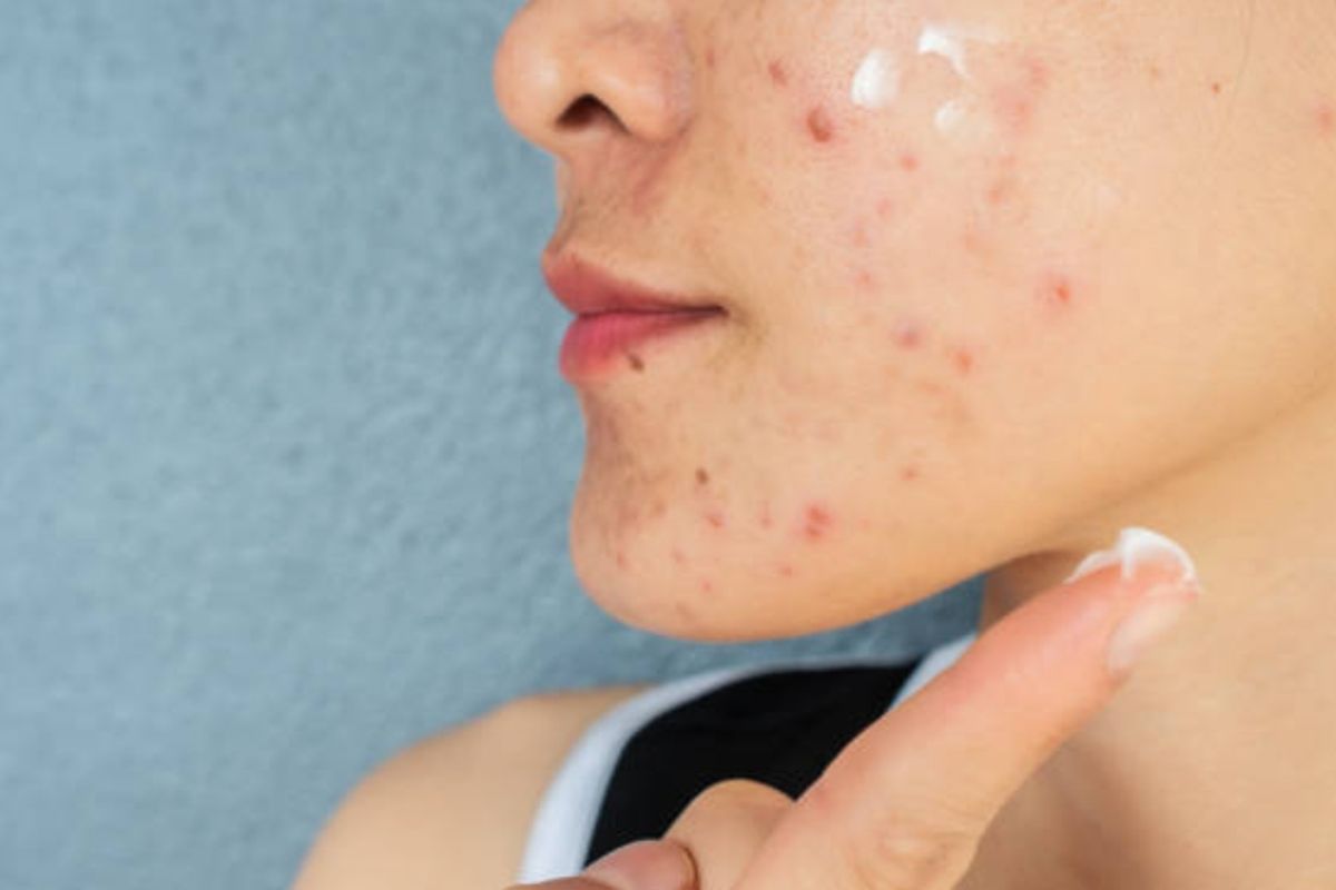 Kondisi Kulit Bisa Jadi Alarm Stres Tubuh, Ini Tandanya Menurut Dokter 